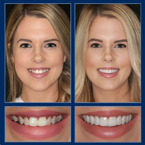 Enhancing Confidence and Self-Esteem with Smile Magic Implants